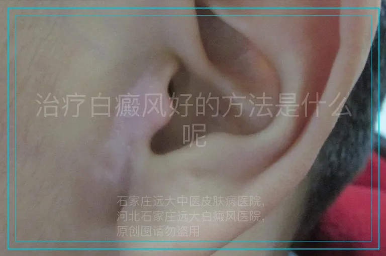 治疗白癜风好的方法是什么呢