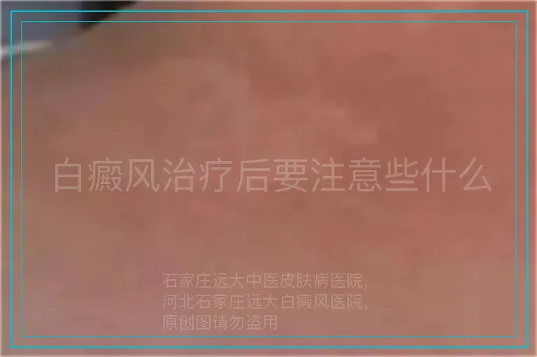白癜风治疗后要注意些什么