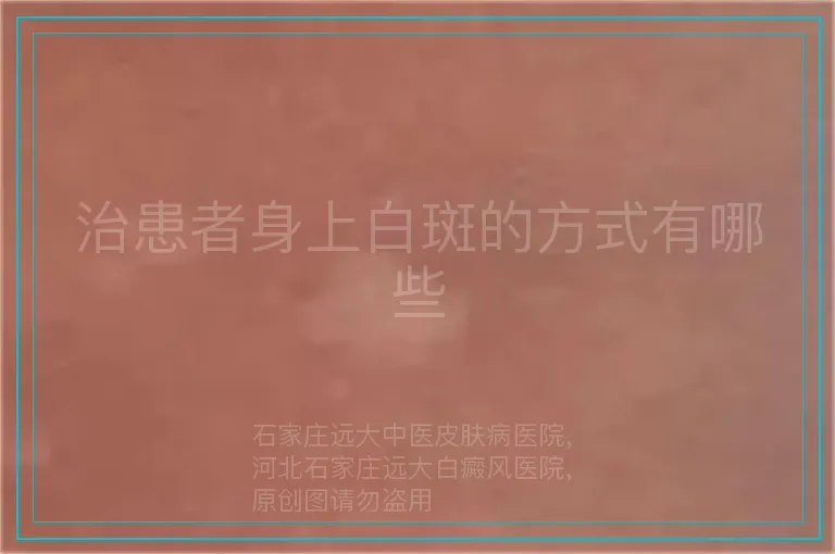 治患者身上白斑的方式有哪些