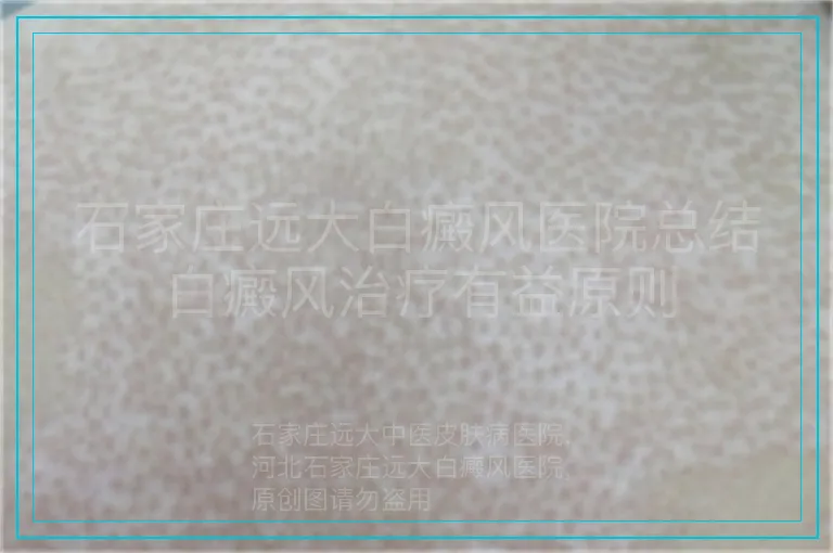 石家庄远大白癜风医院总结白癜风治疗有益原则