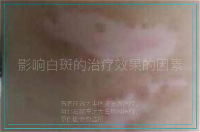 影响白斑的治疗效果的因素