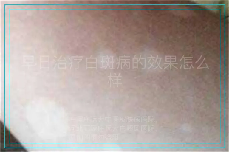 早日治疗白斑病的效果怎么样