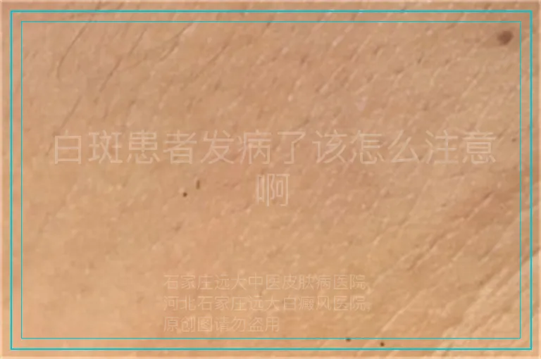 白斑患者发病了该怎么注意啊