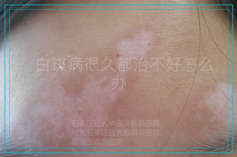 白斑病很久都治不好怎么办