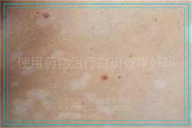 使用药物治疗白斑效果好吗