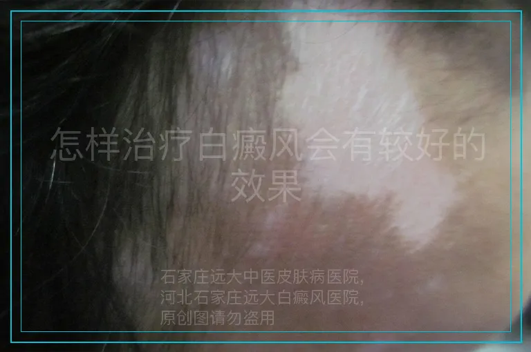 怎样治疗白癜风会有较好的效果