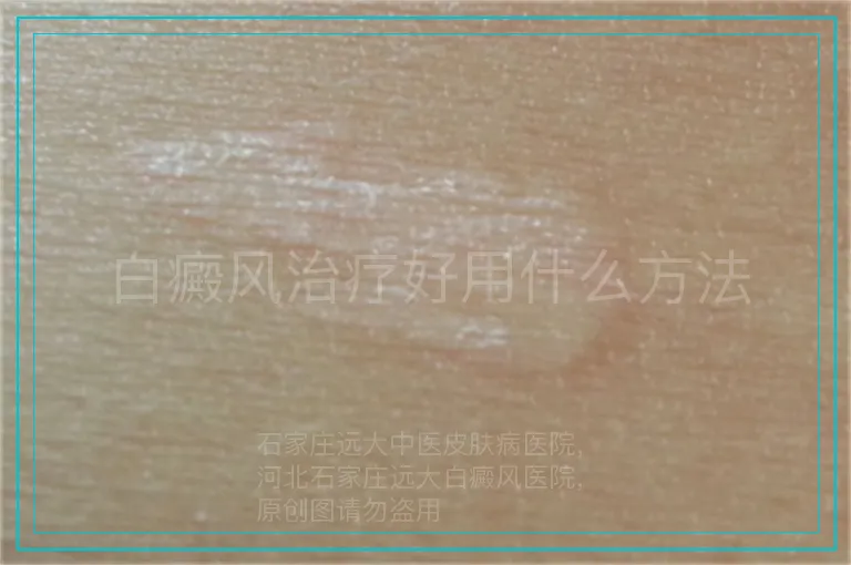 白癜风治疗好用什么方法
