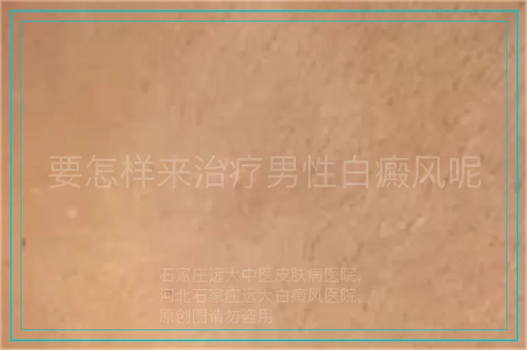要怎样来治疗男性白癜风呢