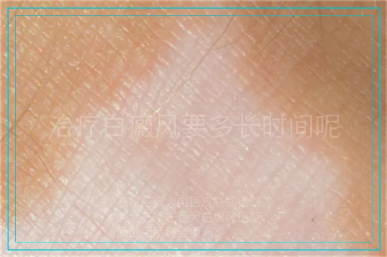 治疗白癜风要多长时间呢