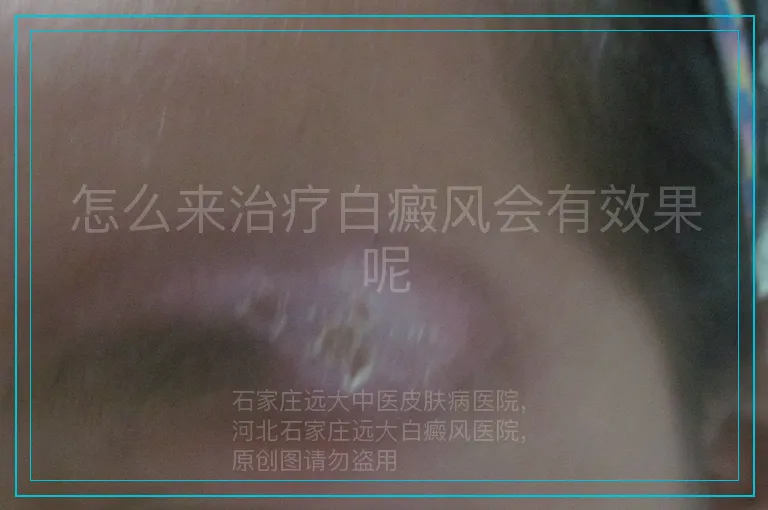 怎么来治疗白癜风会有效果呢