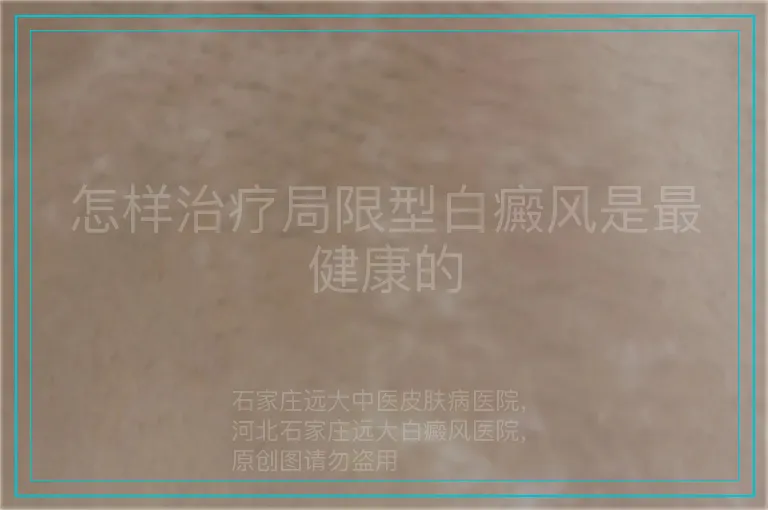 怎样治疗局限型白癜风是最健康的