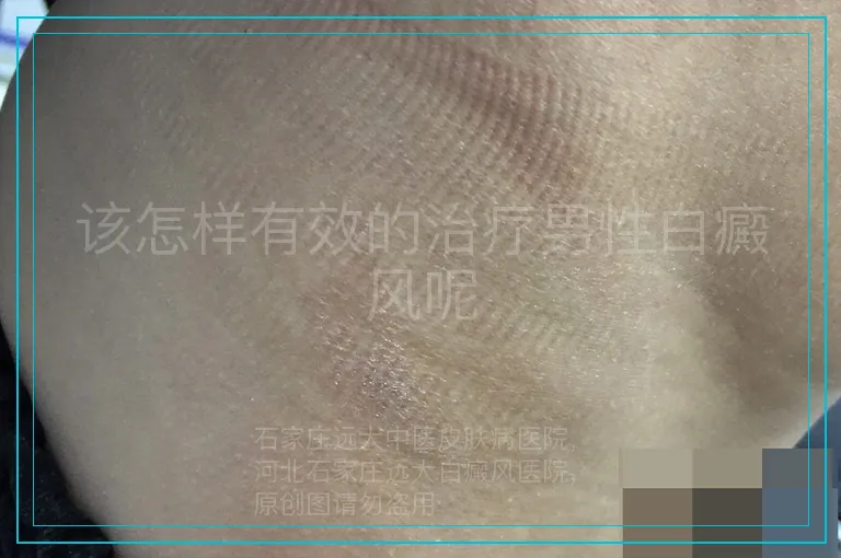 该怎样有效的治疗男性白癜风呢