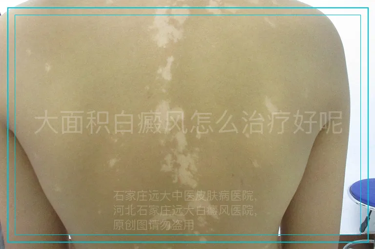 大面积白癜风怎么治疗好呢