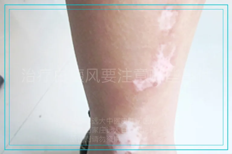 治疗白癜风要注意哪些事情