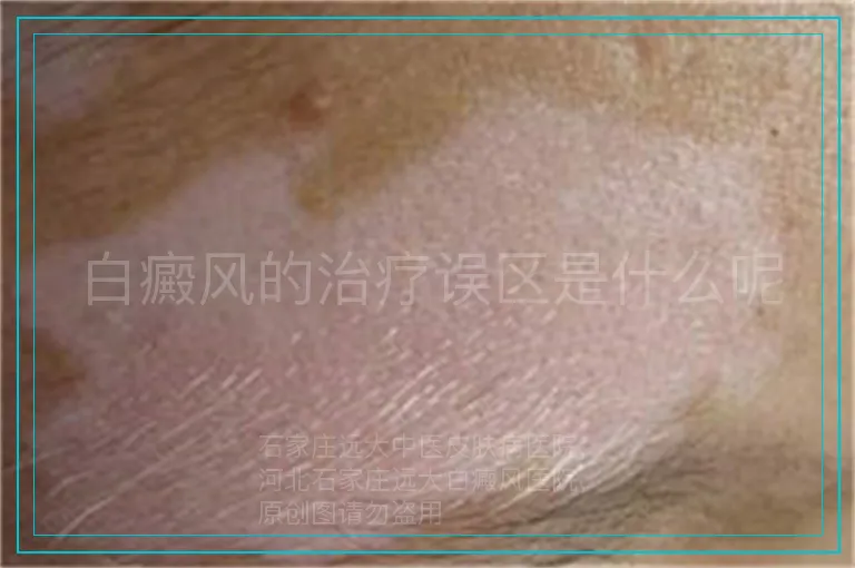 白癜风的治疗误区是什么呢