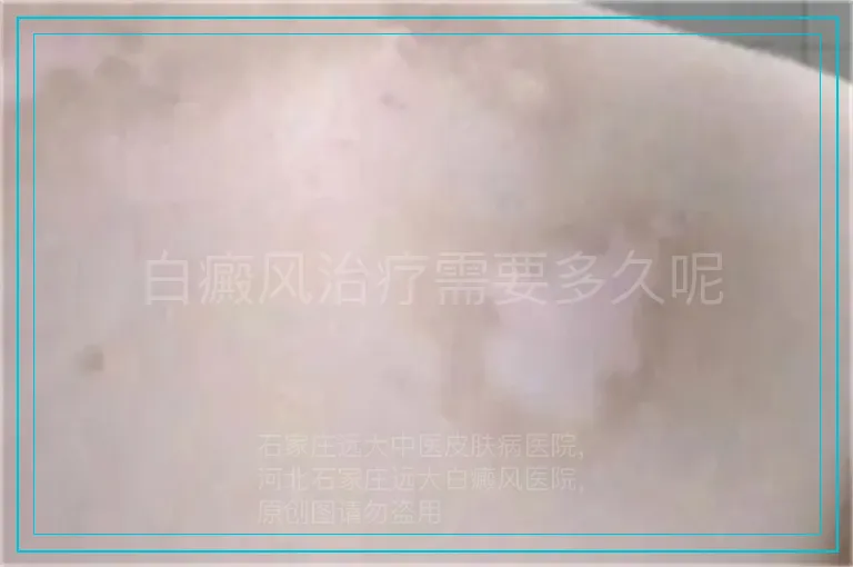 白癜风治疗需要多久呢