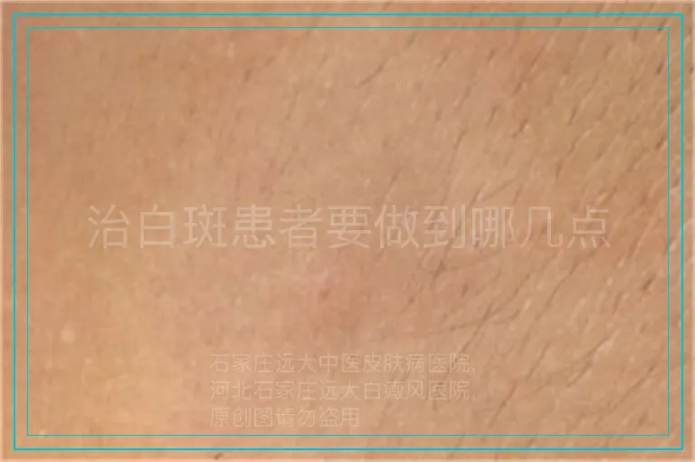 治白斑患者要做到哪几点