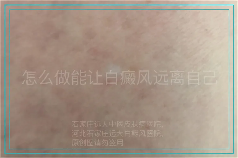怎么做能让白癜风远离自己