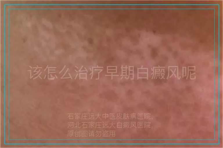 该怎么治疗早期白癜风呢