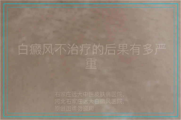 白癜风不治疗的后果有多严重