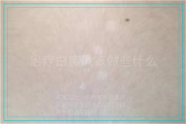 治疗白癜风该做些什么