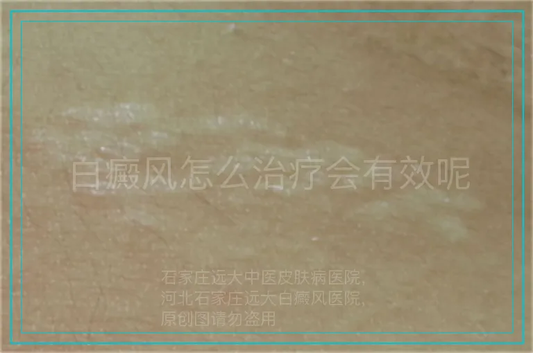 白癜风怎么治疗会有效呢