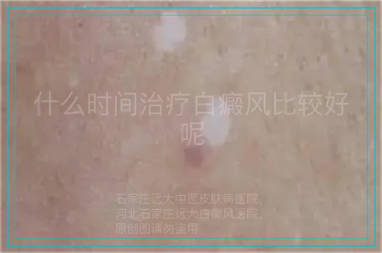 什么时间治疗白癜风比较好呢