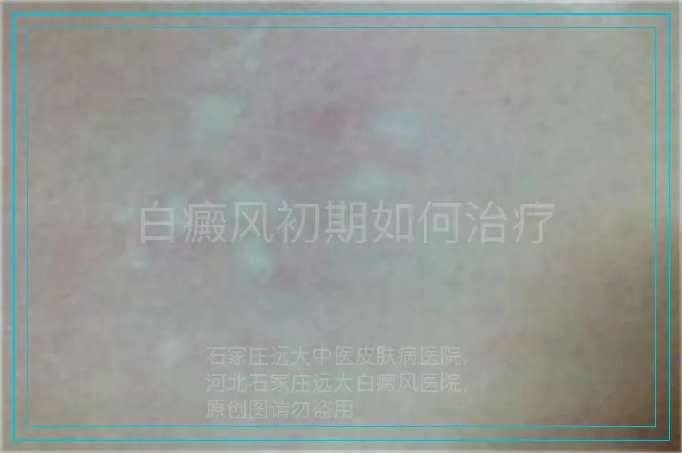 白癜风初期如何治疗