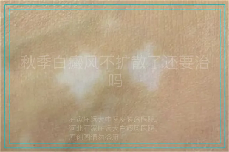 秋季白癜风不扩散了还要治吗