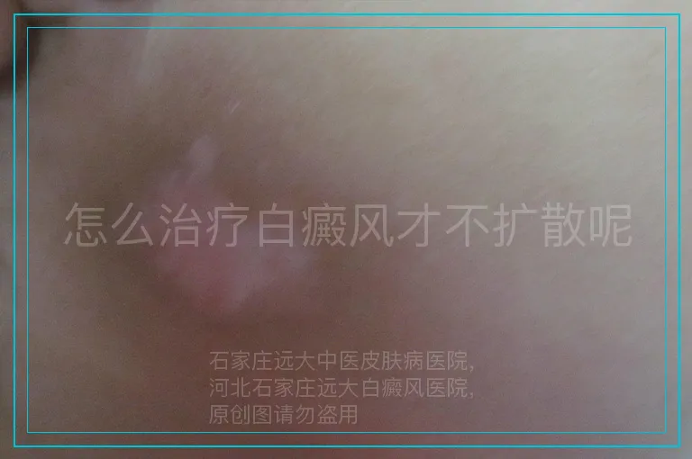 怎么治疗白癜风才不扩散呢