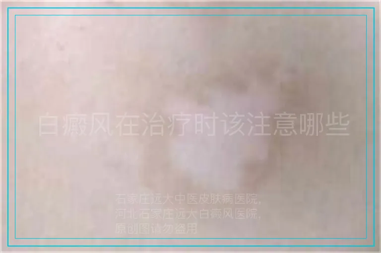 白癜风在治疗时该注意哪些