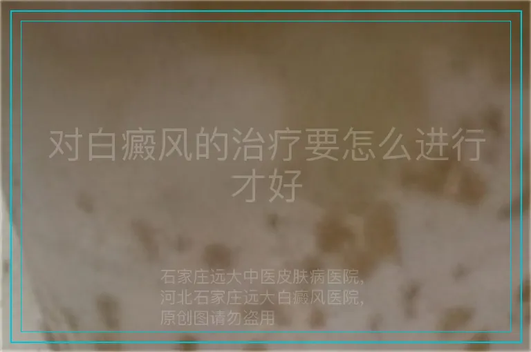 对白癜风的治疗要怎么进行才好