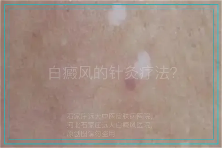 白癜风的针灸疗法?