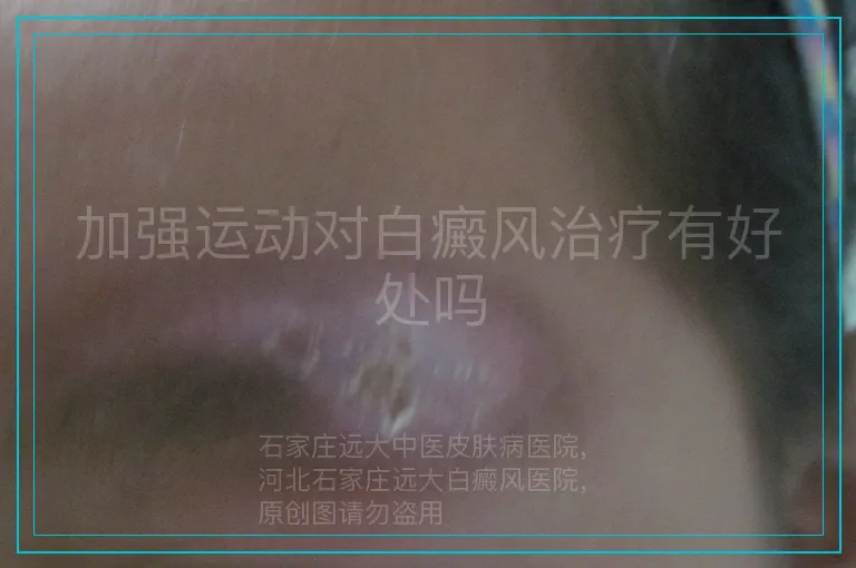 加强运动对白癜风治疗有好处吗