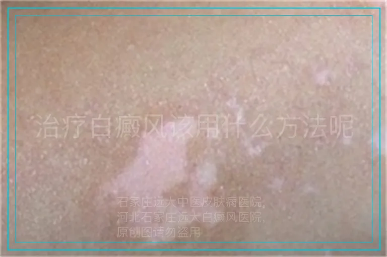 治疗白癜风该用什么方法呢