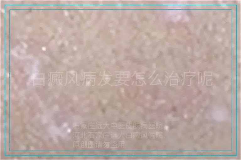 白癜风病发要怎么治疗呢