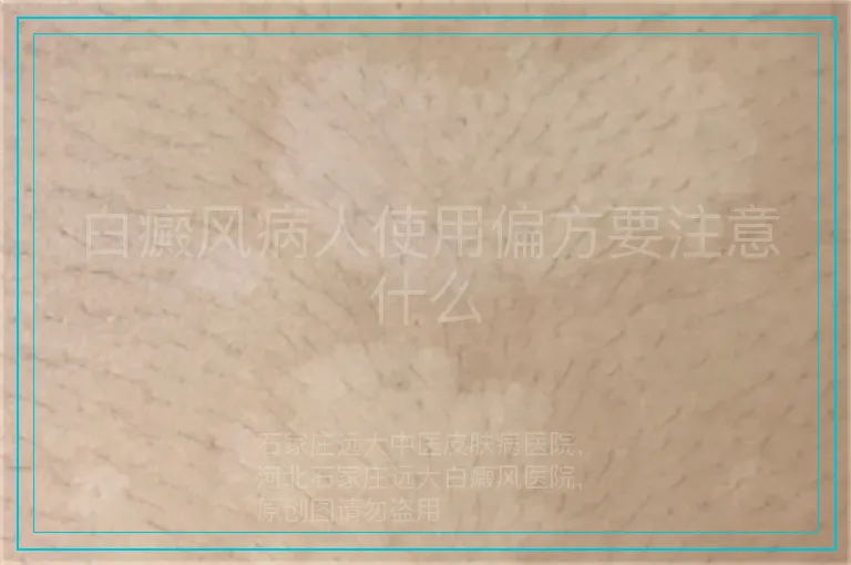 白癜风病人使用偏方要注意什么