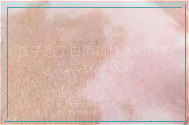孩子患了白癜风什么治疗方法比较有效果