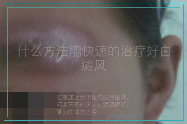什么方法能快速的治疗好白癜风