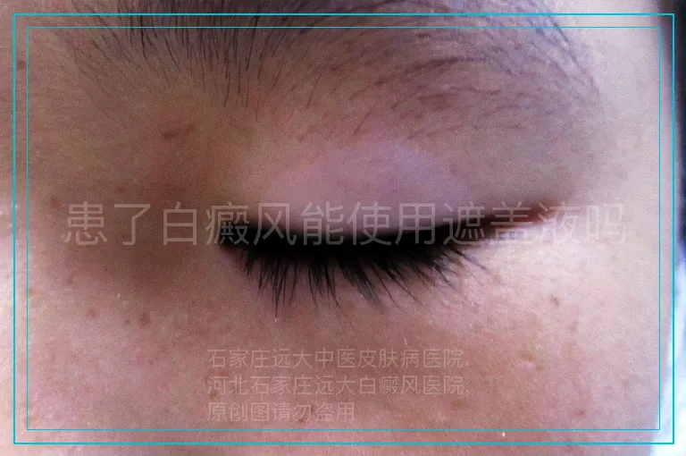 患了白癜风能使用遮盖液吗
