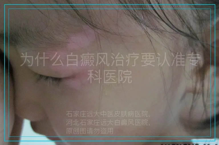 为什么白癜风治疗要认准专科医院