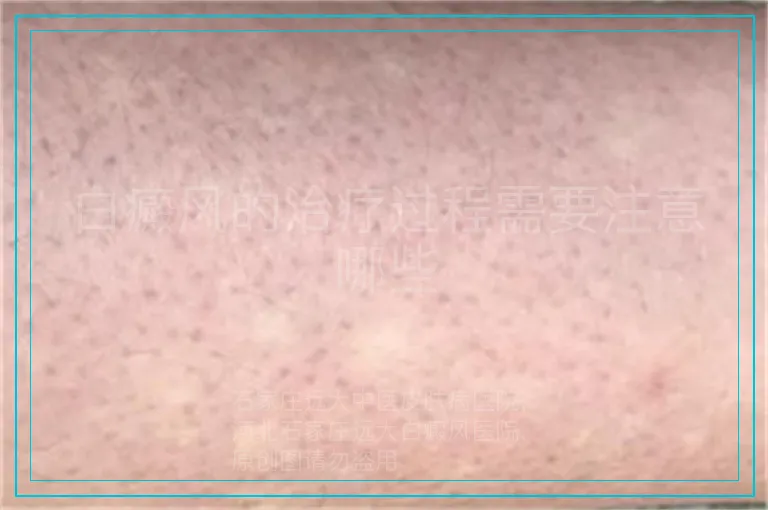白癜风的治疗过程需要注意哪些