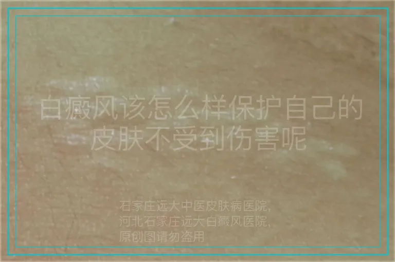 白癜风该怎么样保护自己的皮肤不受到伤害呢