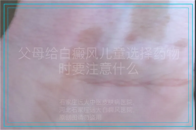 父母给白癜风儿童选择药物时要注意什么