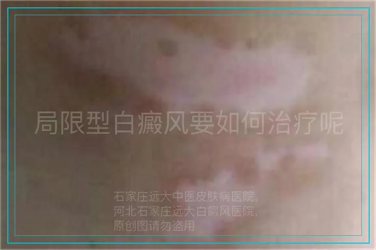 局限型白癜风要如何治疗呢