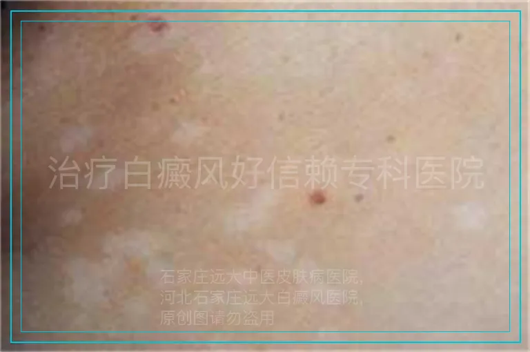 治疗白癜风好信赖专科医院