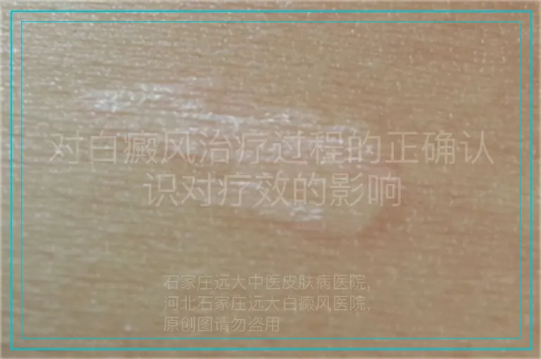 对白癜风治疗过程的正确认识对疗效的影响