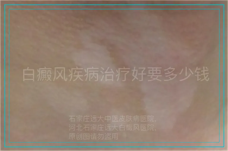 白癜风疾病治疗好要多少钱