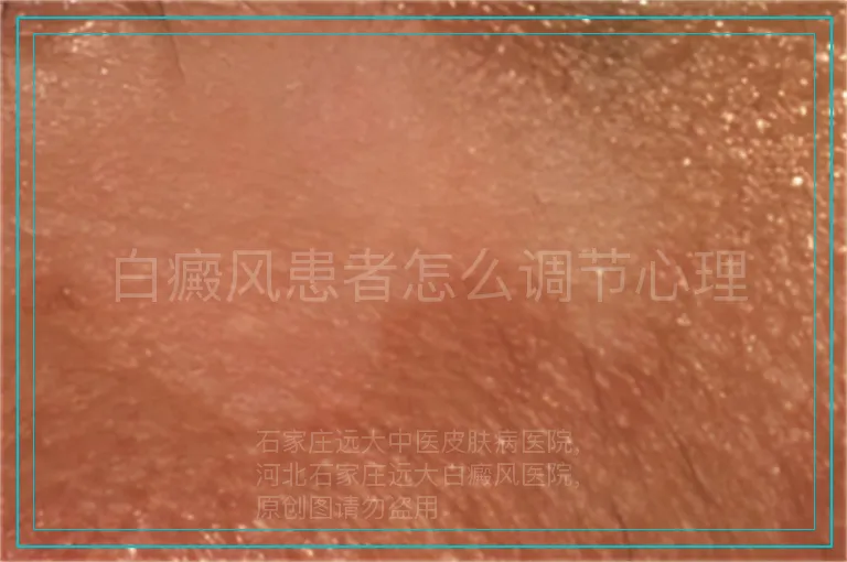 白癜风患者怎么调节心理