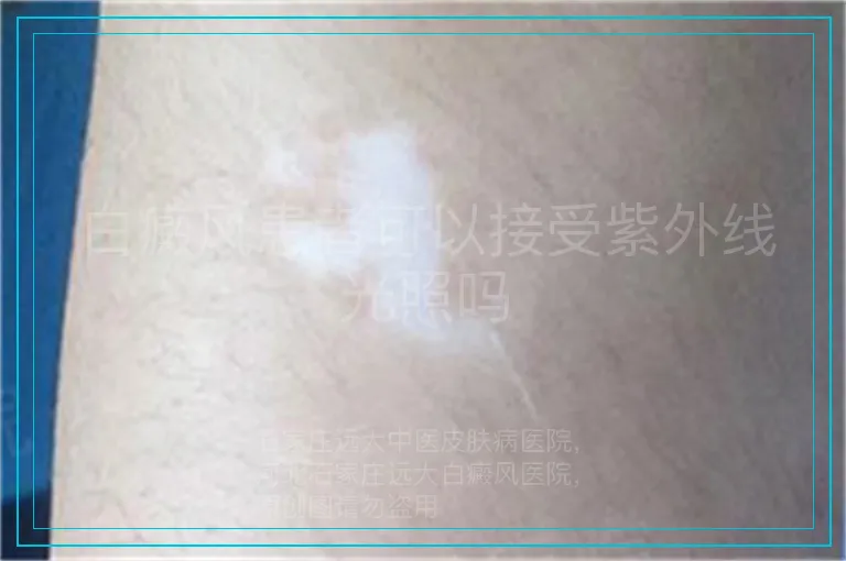 白癜风患者可以接受紫外线光照吗